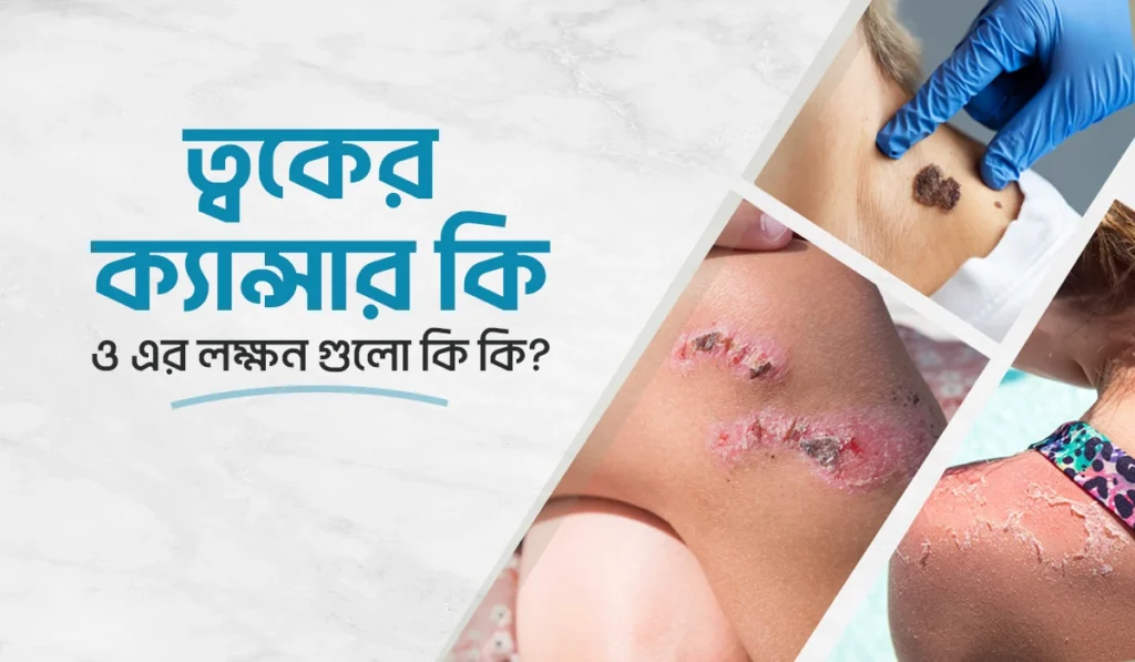 ত্বকের ক্যান্সার কি ও এর লক্ষণ গুলো কি কি?