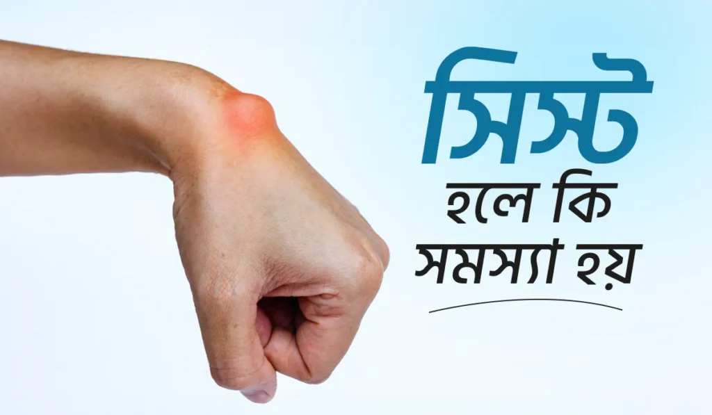 সিস্ট হলে কি সমস্যা হয়?